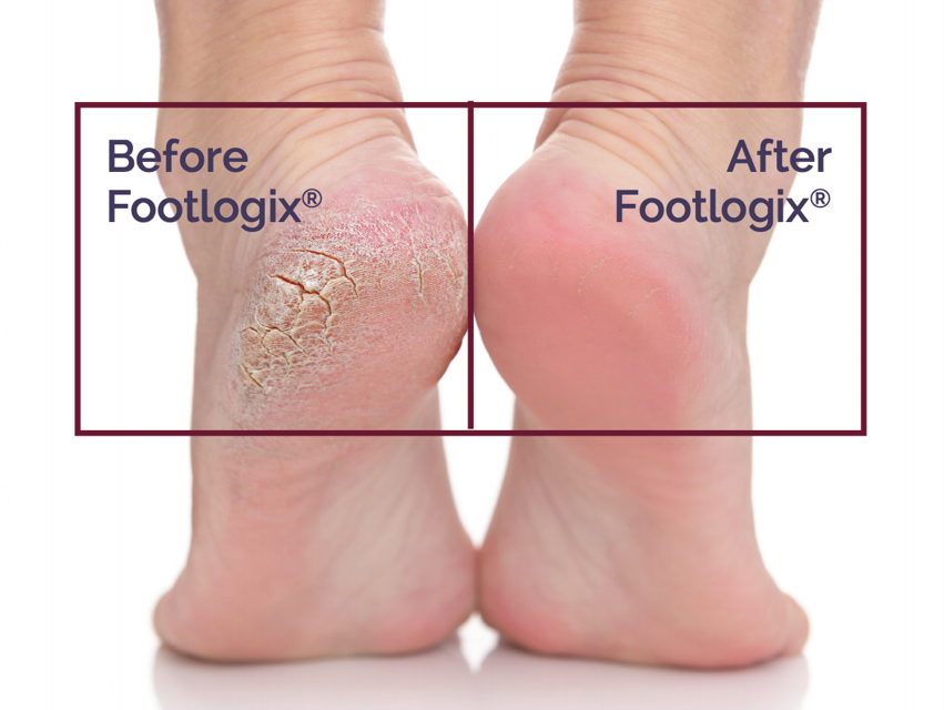 Before Footlogix and After Footlogix Images
