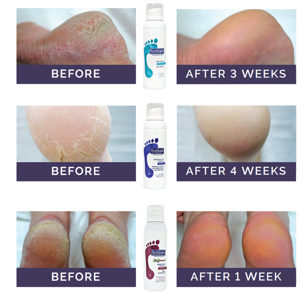 Footlogix Pediceutical Before and After Images
